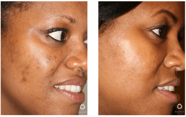 Nashville Perfect Derma Peel - 61Five Health & Wellness The PefectDerma Peel