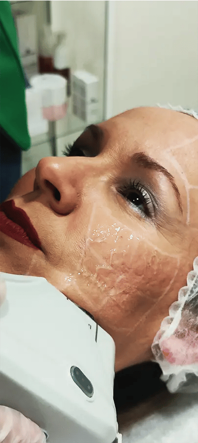 HIFU FACIAL