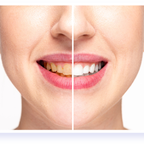 Alternative view of Natural Teeth Whitener – Mouth Detox Whitening System