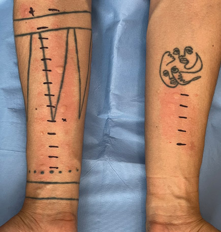 Dra Nancy Cruz alergia