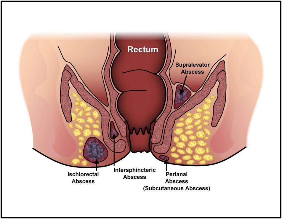 Fistula Doctor in Shimla