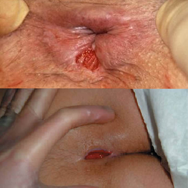 fistula
