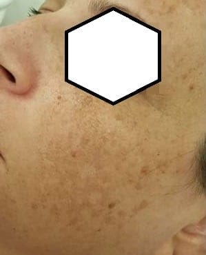 Understanding Pigmentation: Types and Causes Hyperpigmentation