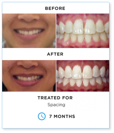 SureSmile BEFORE-AND-AFTER-4