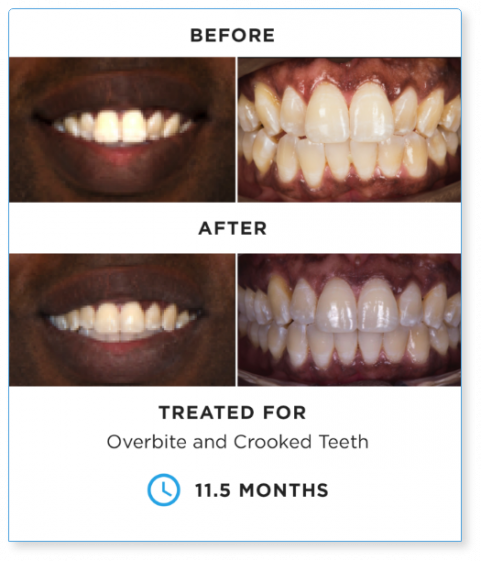 SureSmile BEFORE-AND-AFTER-3