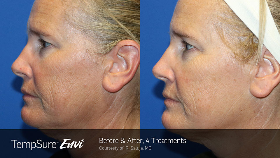TempSure Envi Before and After