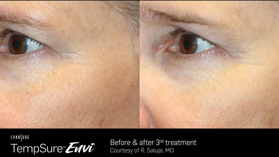 TempSure Envi Before and After
