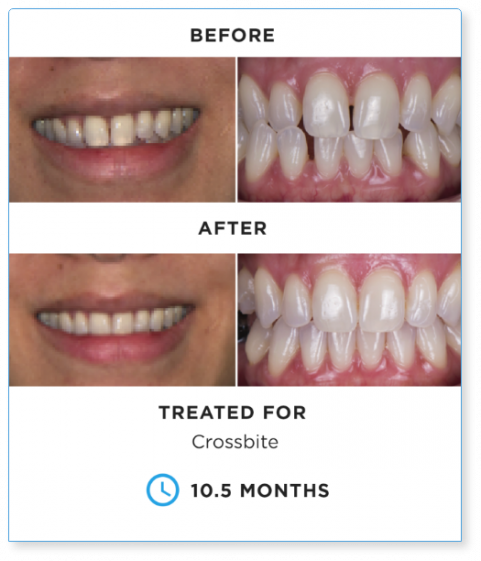 SureSmile BEFORE-AND-AFTER-2