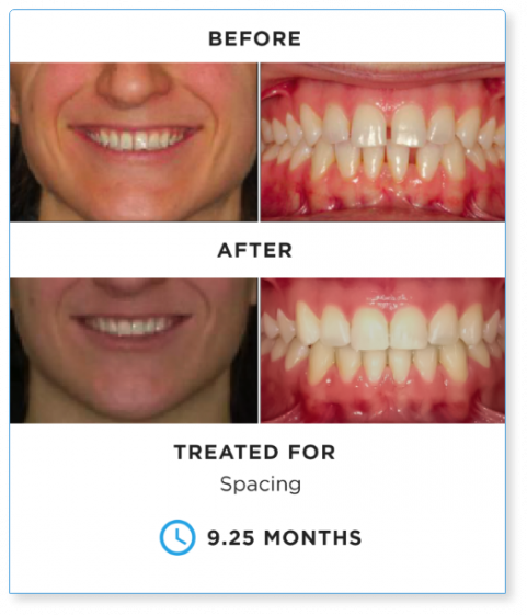SureSmile BEFORE-AND-AFTER-1