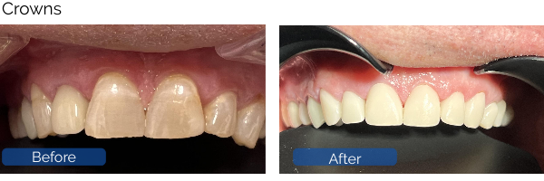 Crowns Before After
