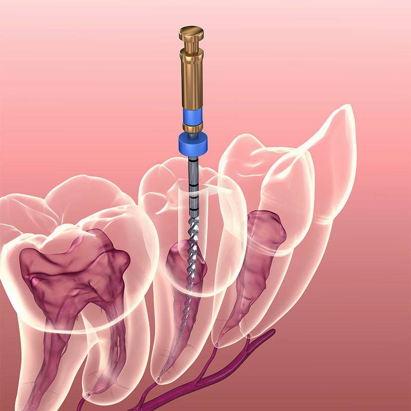 endodoncia (1) Endodoncia en Altea