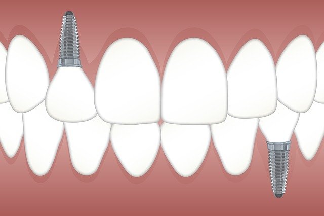 implantes dentales en alicante Implantes dentales