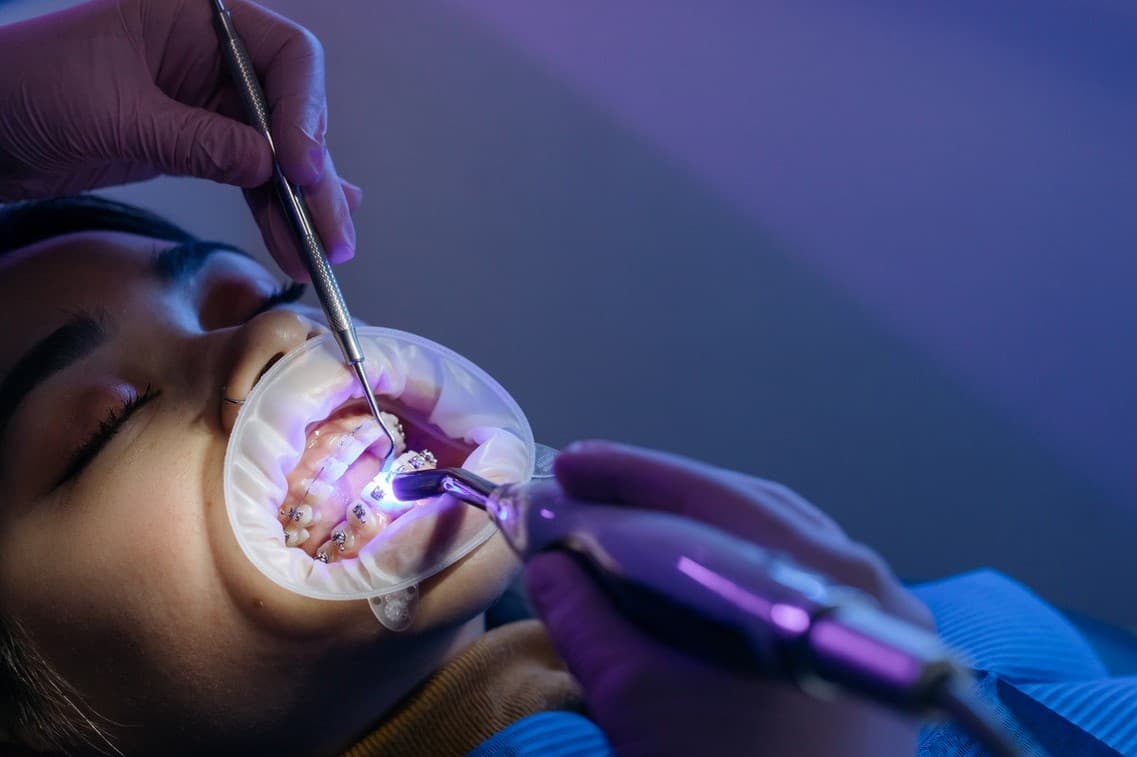 Mini implant ortodontyczny - co to jest?