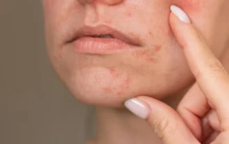 peau à imperfections