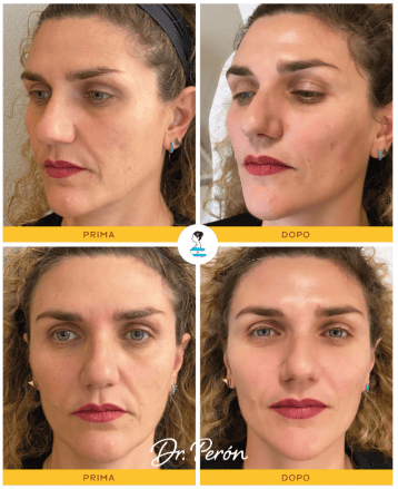 rughe-nasolabiali-filler