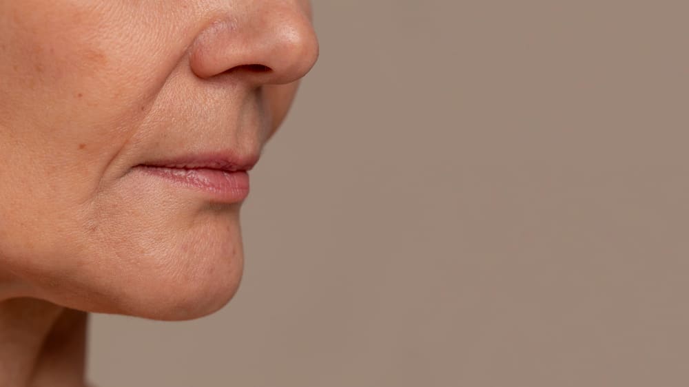 rughe-nasolabiali-filler-bologna