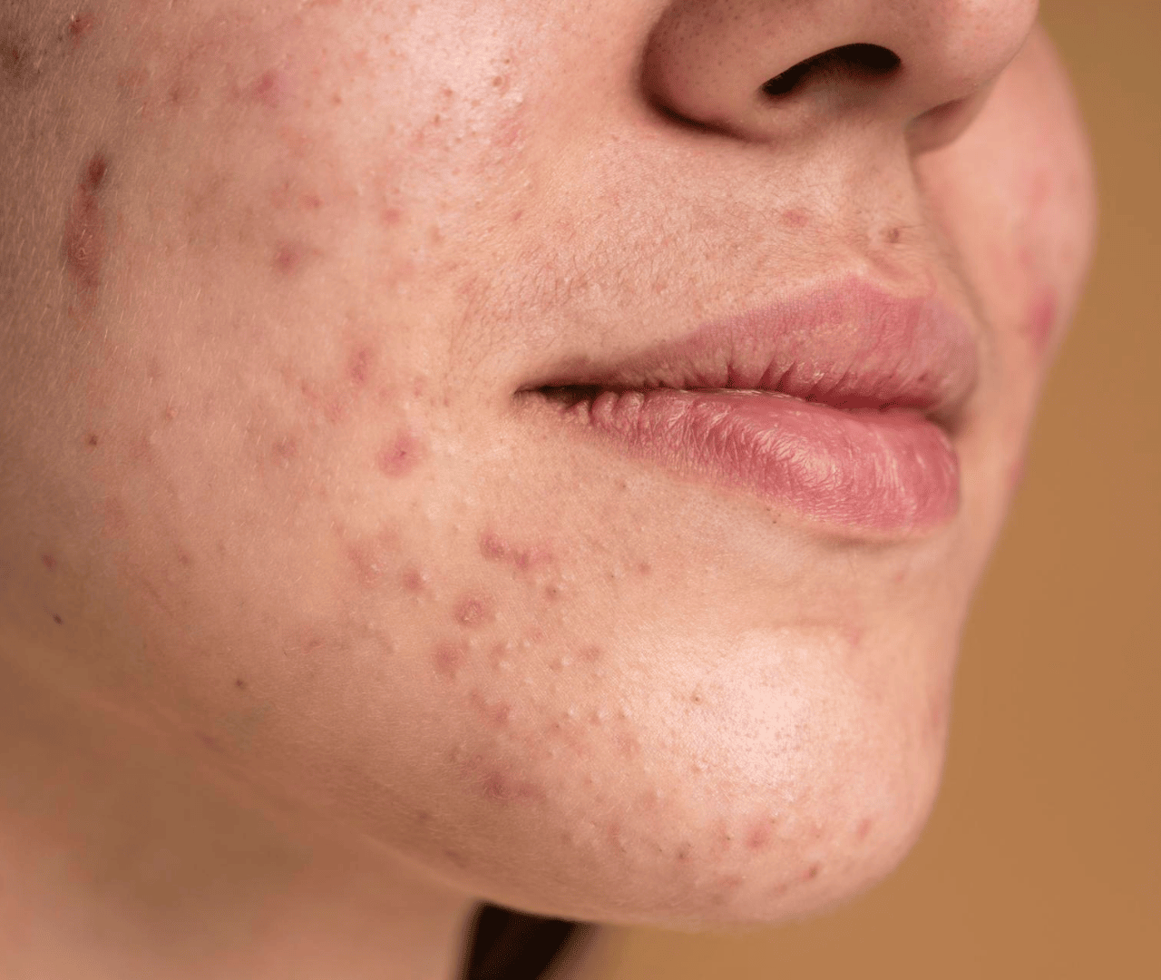 Pasos para sacar puntos negros y espinillas | Sin lastimar la piel