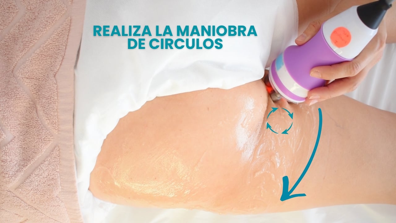 Maniobra de círculos con radiofrecuencia para tratar celulitis en glúteos.