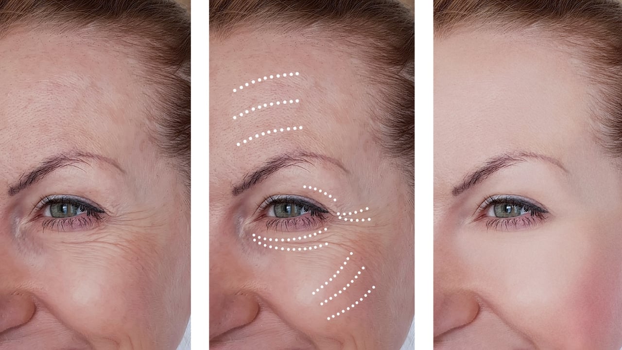Comparación de antes y después del tratamiento de radiofrecuencia facial mostrando reducción de arrugas y lifting natural.