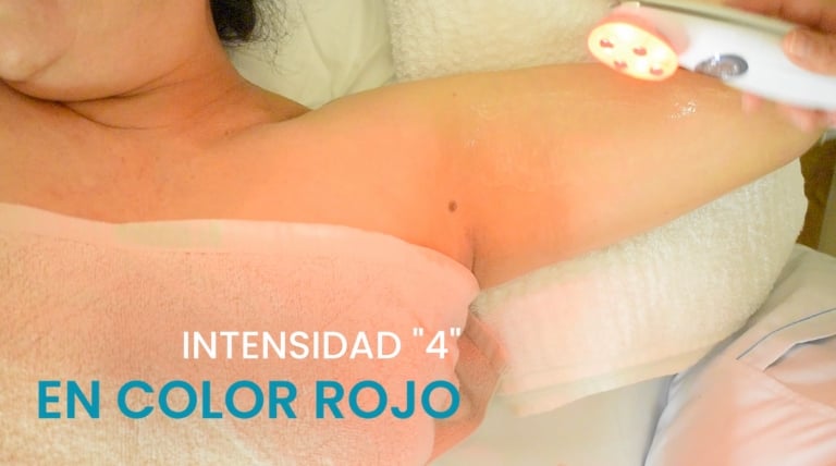 Pasos clave para aplicar electroestimulación en la zona del brazo desde la axila hasta el codo.