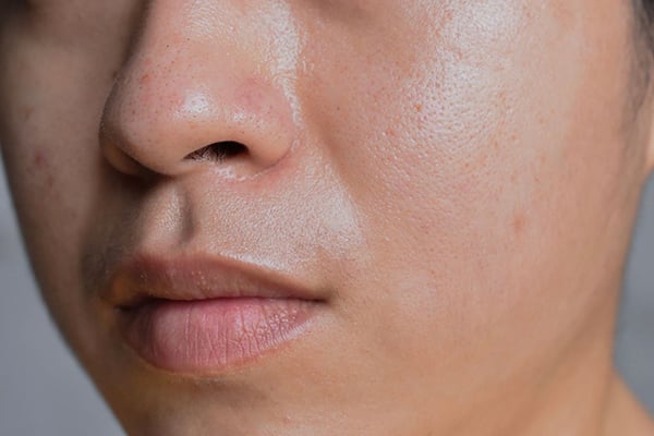 Así luce una piel grasa TIPO DE PIEL GRASA