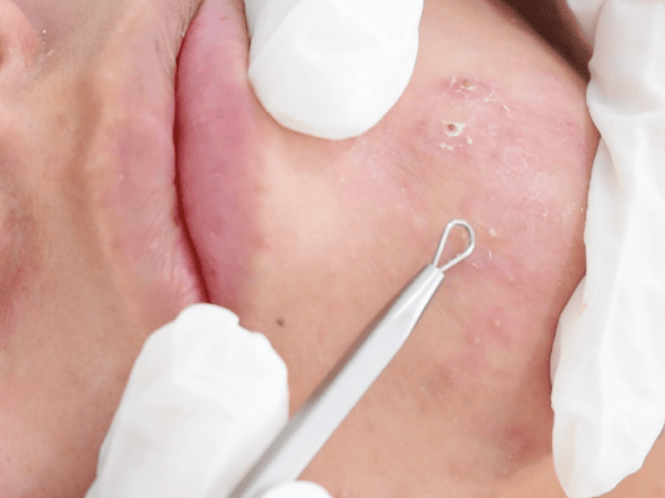 Procedimiento para retirar puntos negros y espinillas Técnica para retirar puntos negros y espinillas