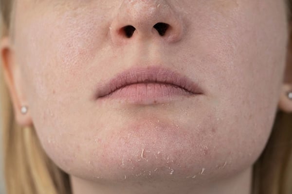 Así luce una piel seca TIPO DE PIEL SECA