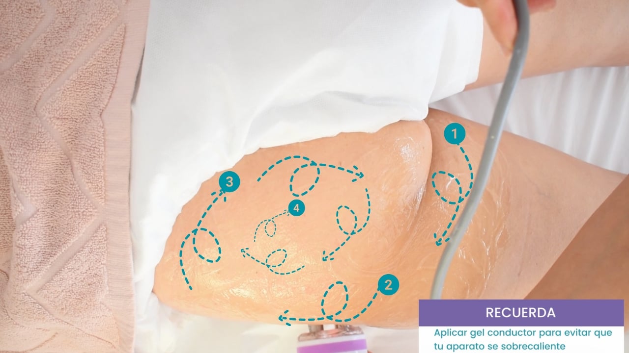 Esquema de técnica en espiral con radiofrecuencia para tratamiento anticelulítico.