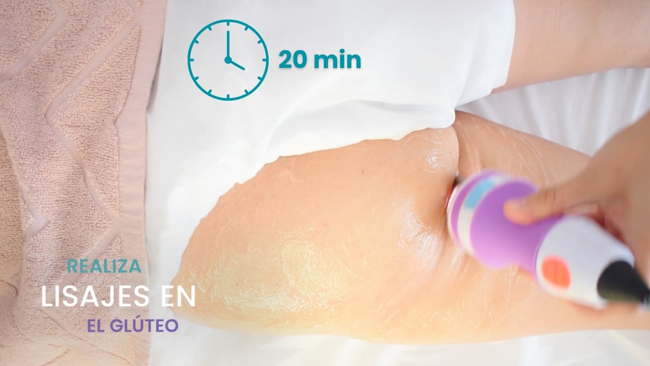 Indicador visual del tiempo recomendado para tratamiento de radiofrecuencia en glúteos.