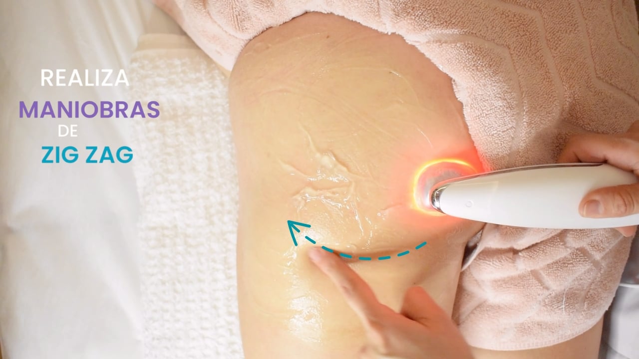 Aplicación de la técnica de zigzag en el pliegue del glúteo con electroestimulación.