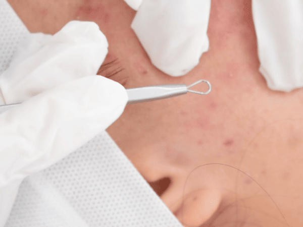 Identificando los puntos negros y espinillas Identifica los puntos negros y espinillas