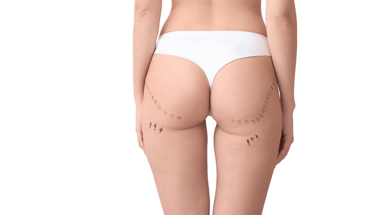 Aplicación de radiofrecuencia en glúteos para mejorar flacidez y estimular colágeno.