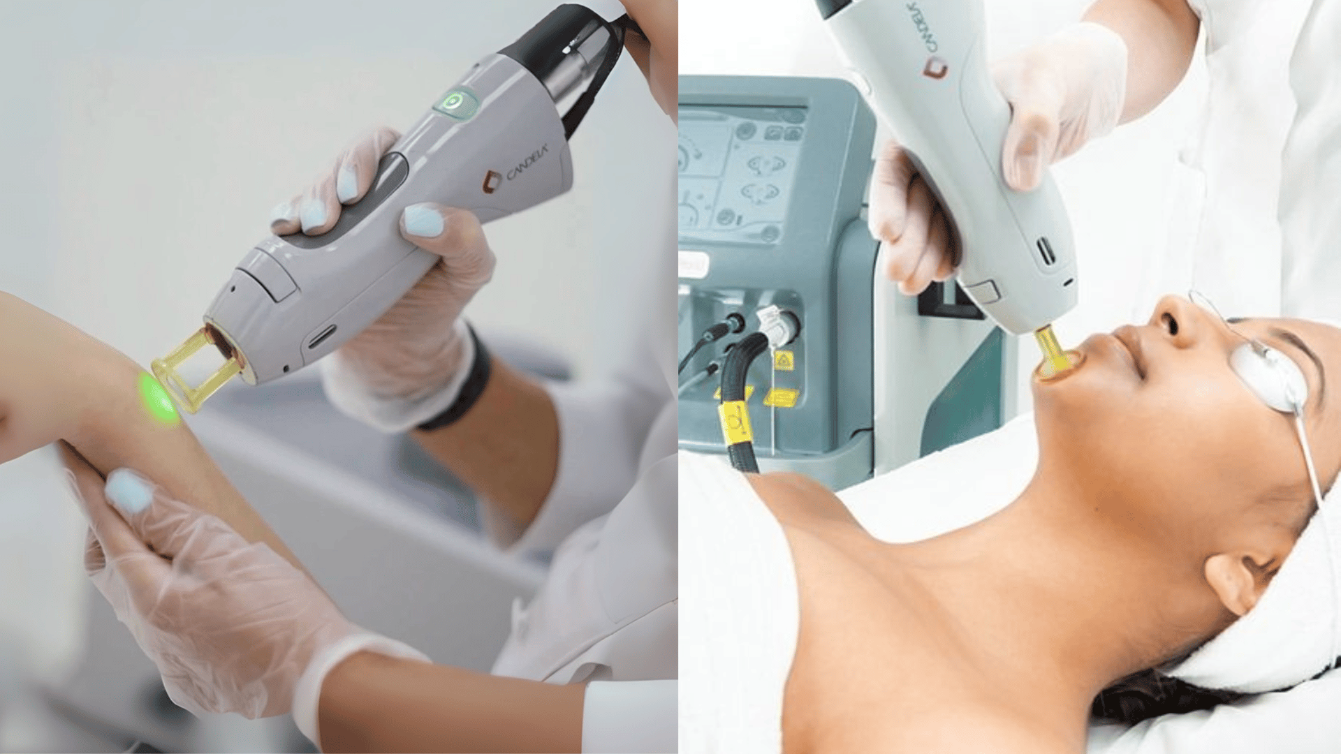How Laser Hair Removal Works