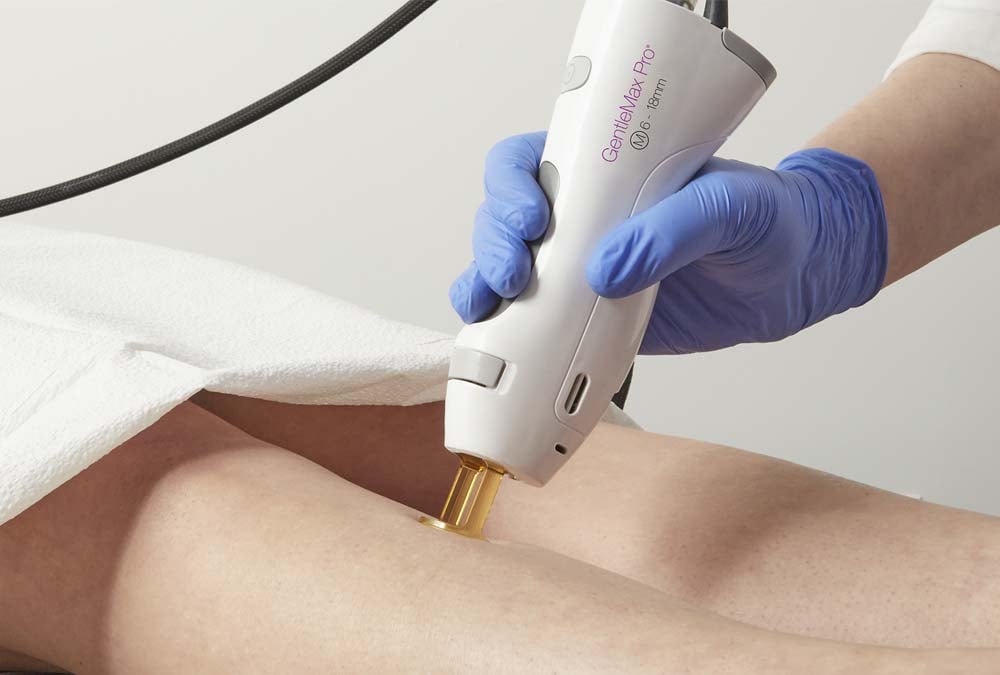 Full Body Laser Hair Removal