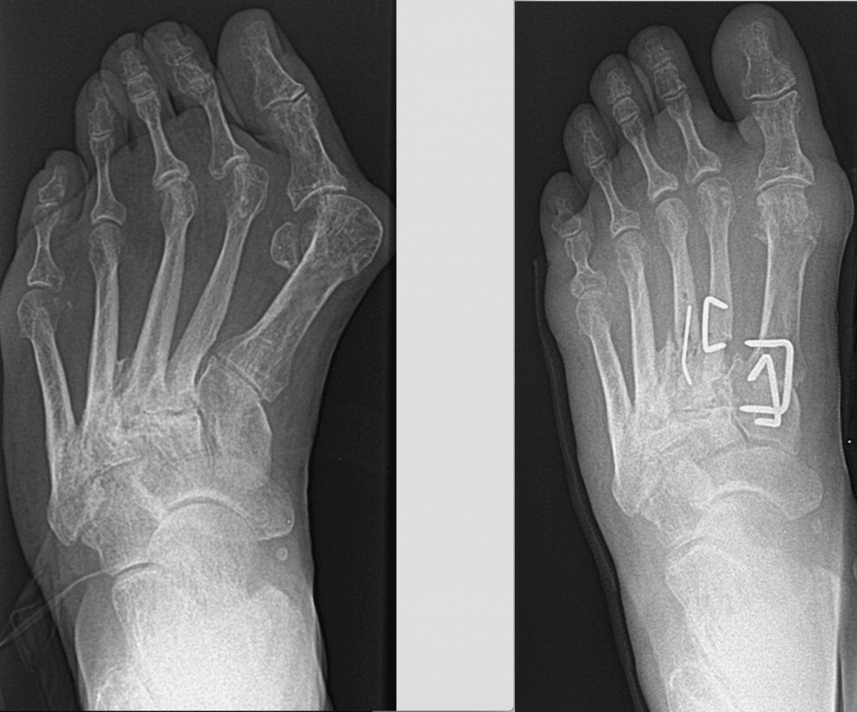 pt01hallux3 0