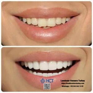 Laminate Veneers Turkey 3 Laminate Veneers Turkey is the key to transforming your smile with custom Laminate Teeth