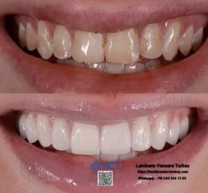 Laminate Veneers Turkey 12 Laminate Veneers Turkey is a top choice for affordable dental tourism with Laminate Teeth.