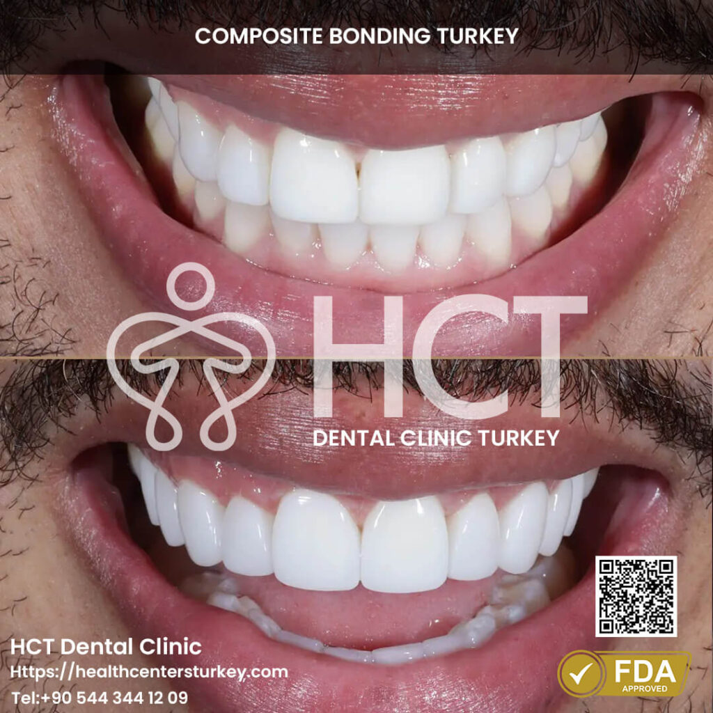 Composite Bonding Turkey Cost - Benefits - Package Deals 4 Small tooth gaps closed with composite bonding treatment.