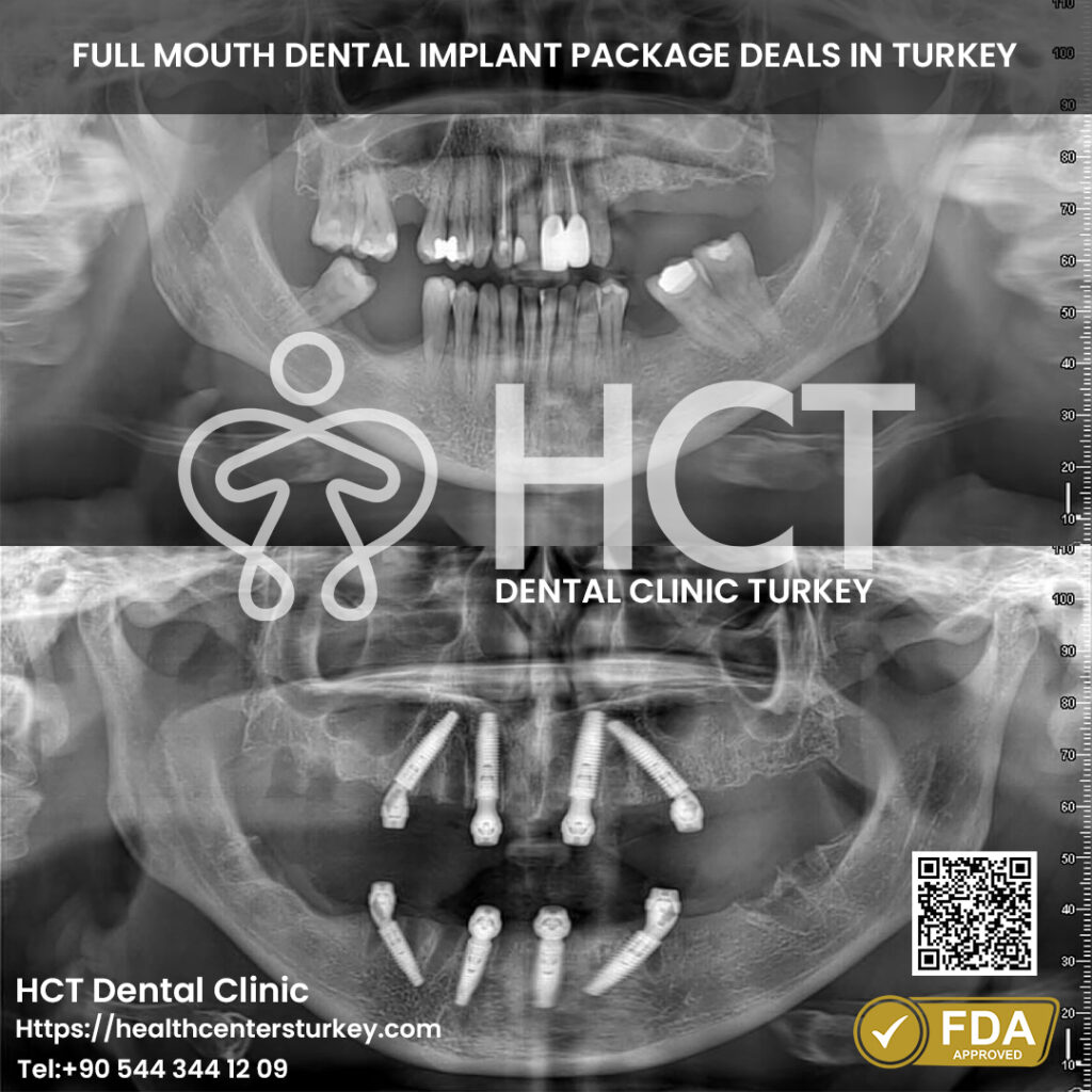 Full Mouth Dental Implants in Turkey 23 Best clinic reviews for All-on-4 dental implants Turkey
