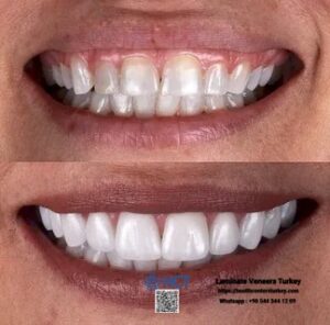 Laminate Veneers Turkey 18 Laminate Veneers Turkey combines artistry and technology to create perfect Laminate Teeth.
