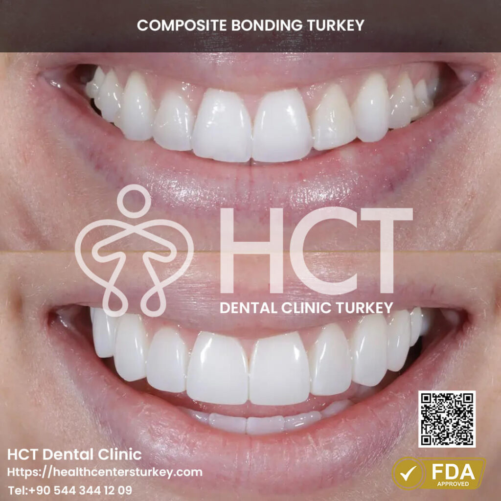 Composite Bonding Turkey Cost - Benefits - Package Deals 21 A same-day composite bonding treatment result from Turkey.