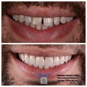 Laminate Veneers Turkey 6 Laminate Veneers Turkey uses advanced technology to design perfect Laminate Teeth.