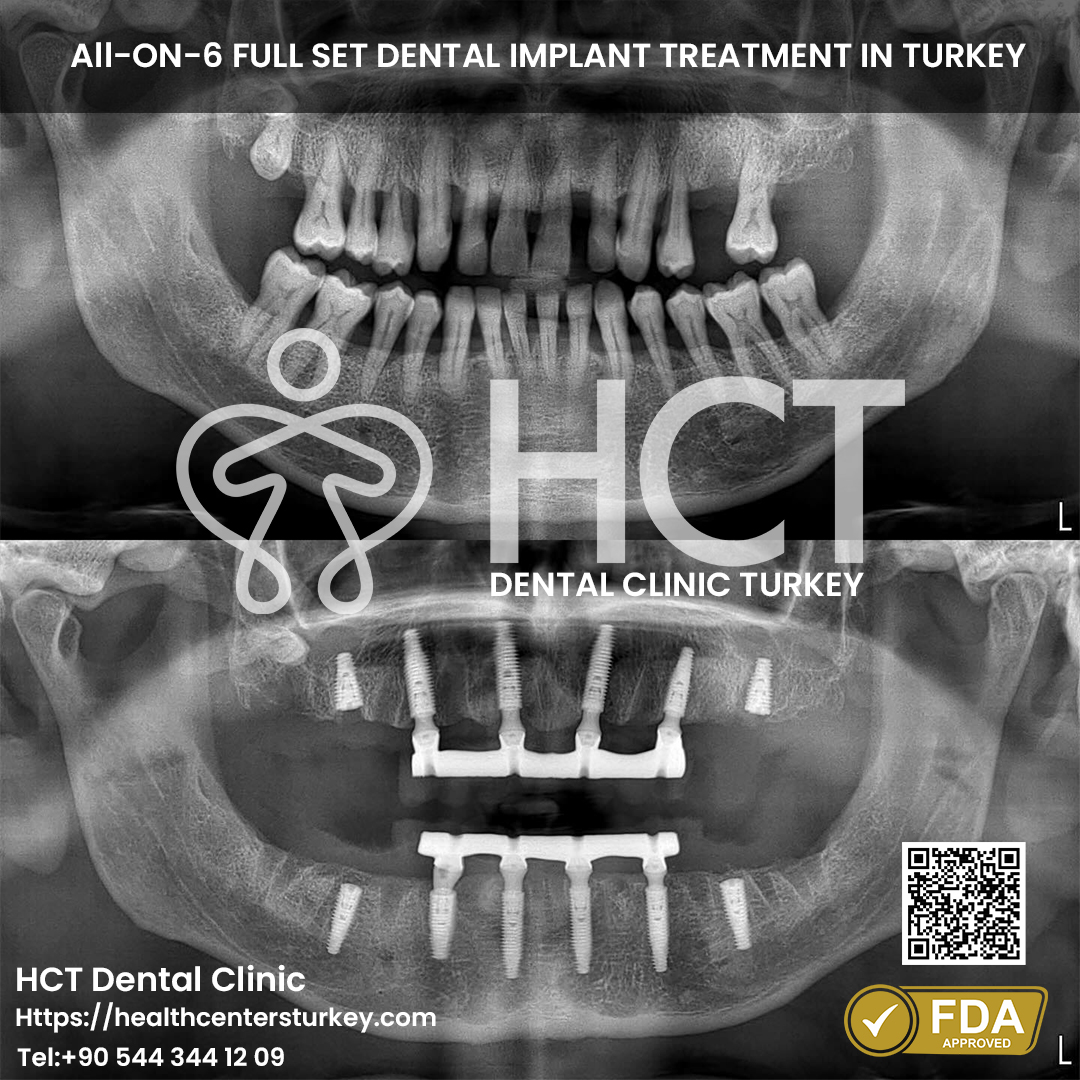 All on 6 Dental Implant in Turkey 2 cheap all on 6 full set dental implants turkey package deals before after x-ray picture