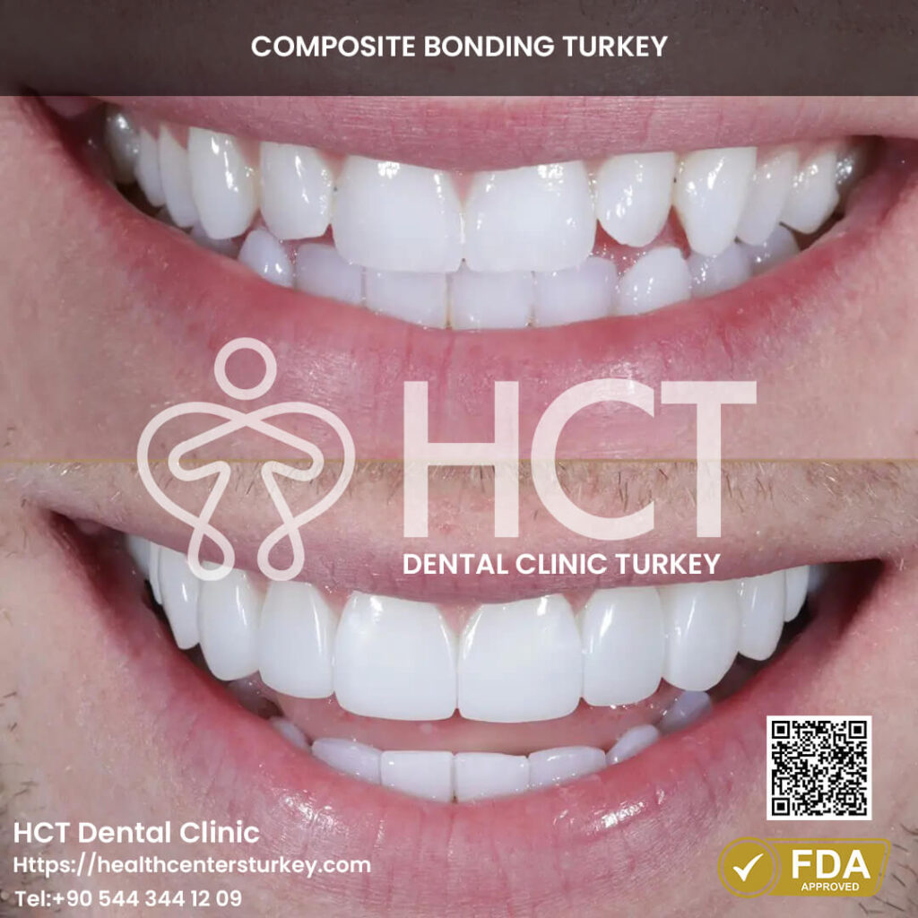 composite bonding results