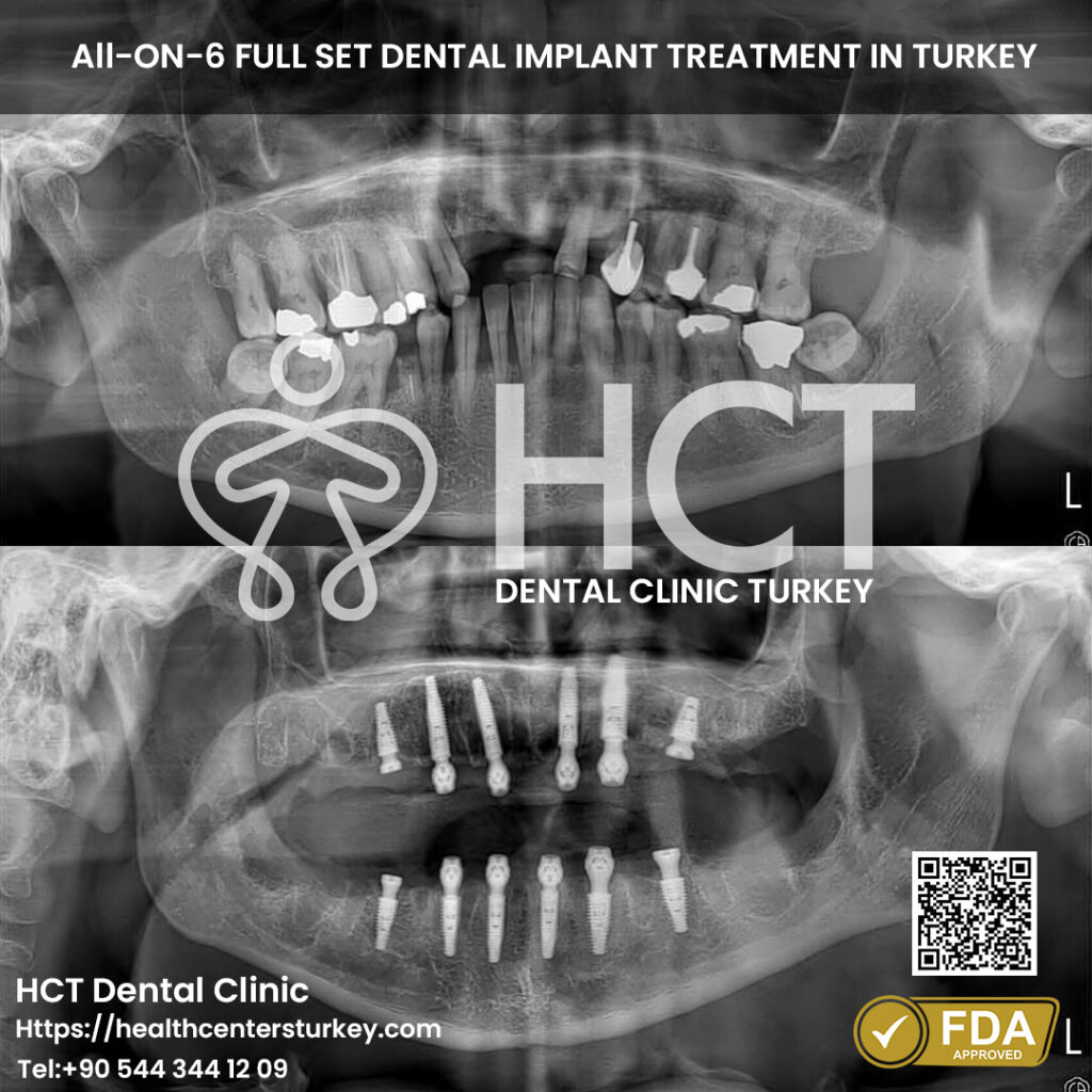 Full Mouth Dental Implants in Turkey 16 full mouth dental implant turkey package deals x-ray before after