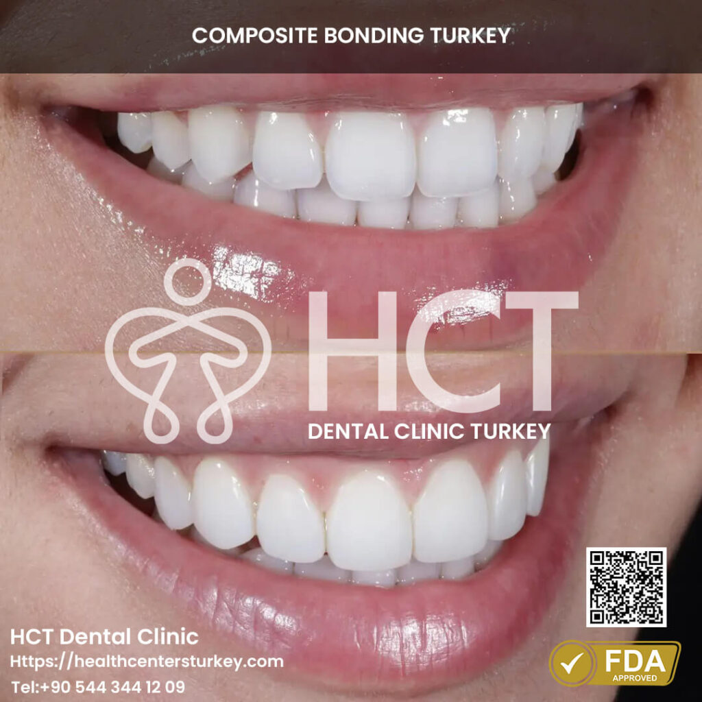 Composite Bonding Turkey Cost - Benefits - Package Deals 9 Before and after composite bonding for restoring worn tooth edges.