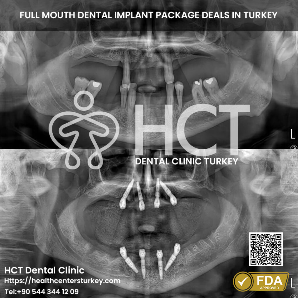 Full Mouth Dental Implants in Turkey 14 Best All-on-4 dental implants cost in Turkey, available in Antalya and Istanbul