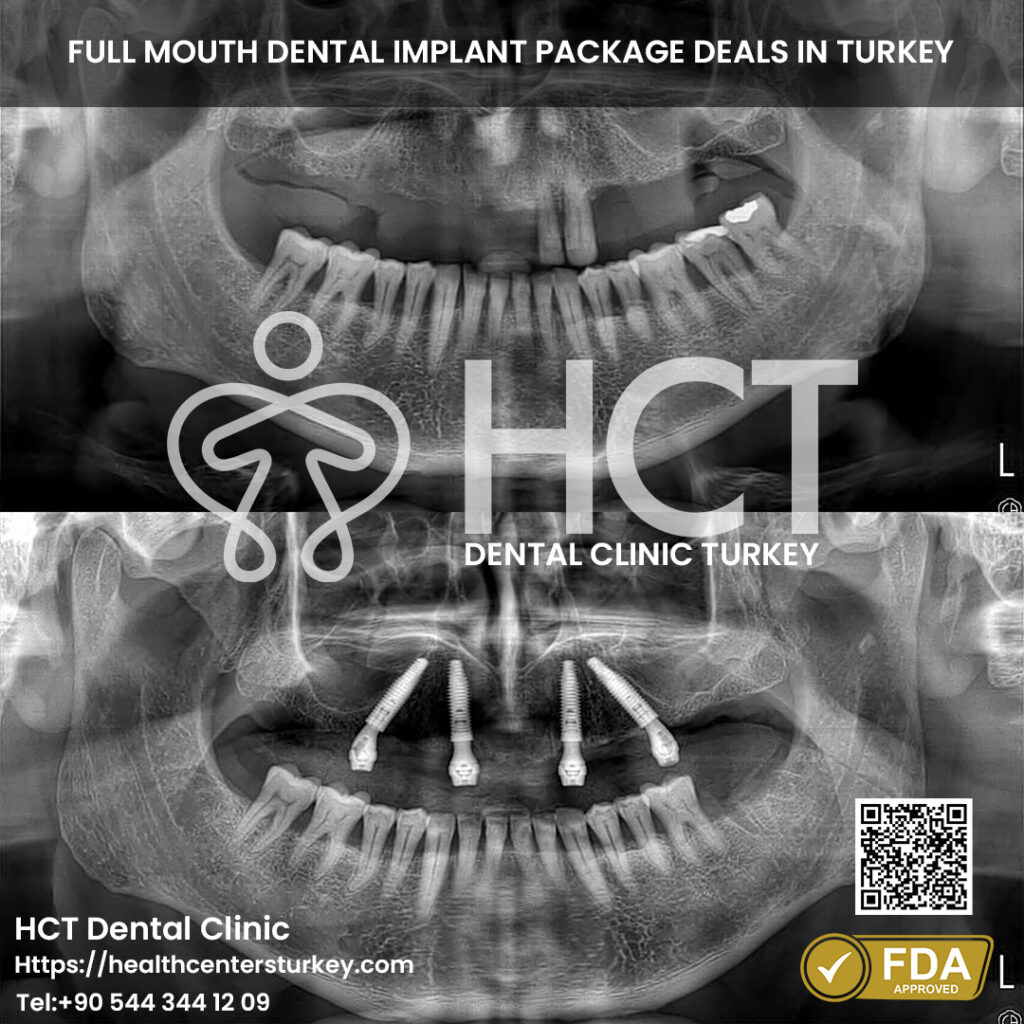 Full Mouth Dental Implants in Turkey 21 All-on-4 dental implants surgery process in Turkey for full arch restoration