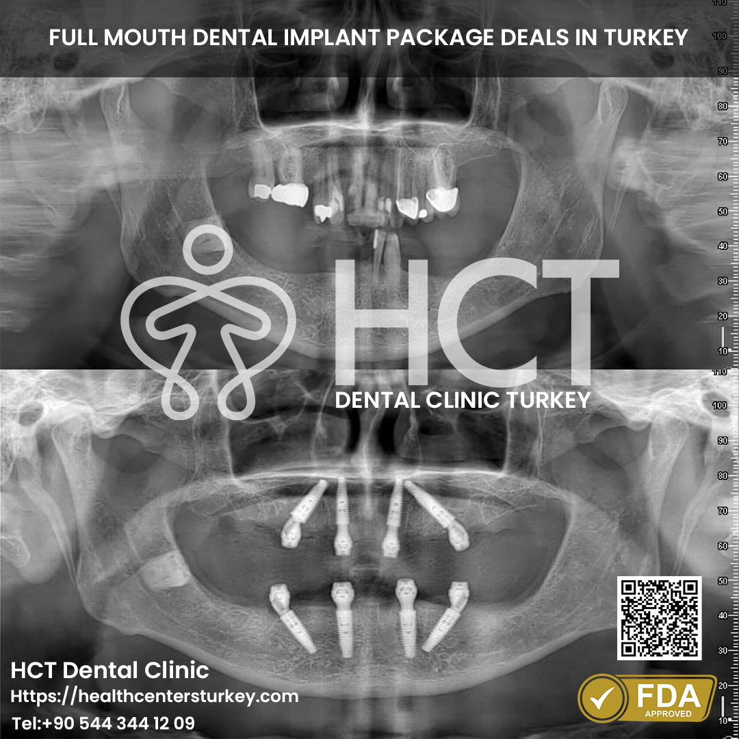 All on 6 Dental Implant in Turkey 15 Affordable All-on-4 dental implants Turkey package price and deals