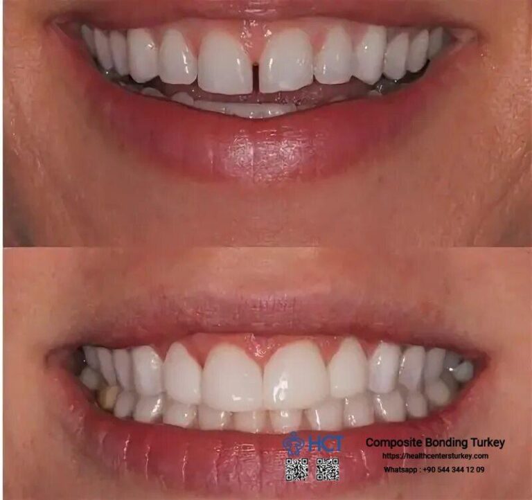 Reliable Smile Alignment Solutions available in Turkey